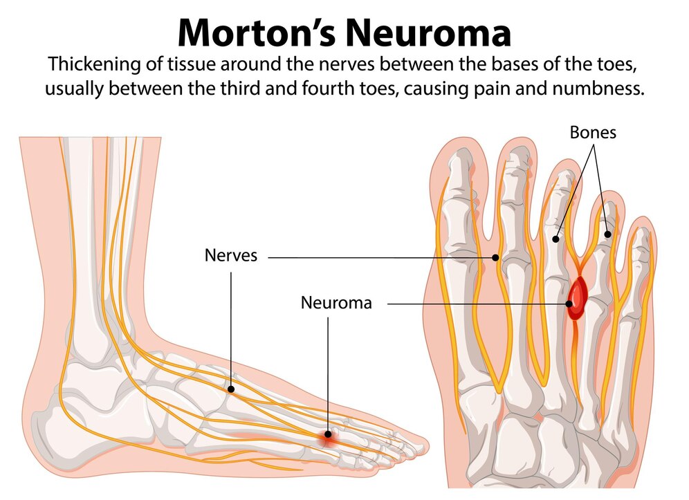 Understanding the Different Types of Neuropathic Pain
