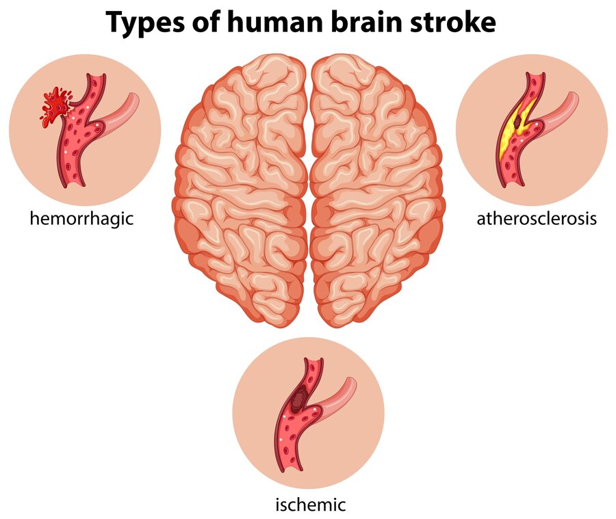 Understanding the Mechanisms of Neuroinflammation