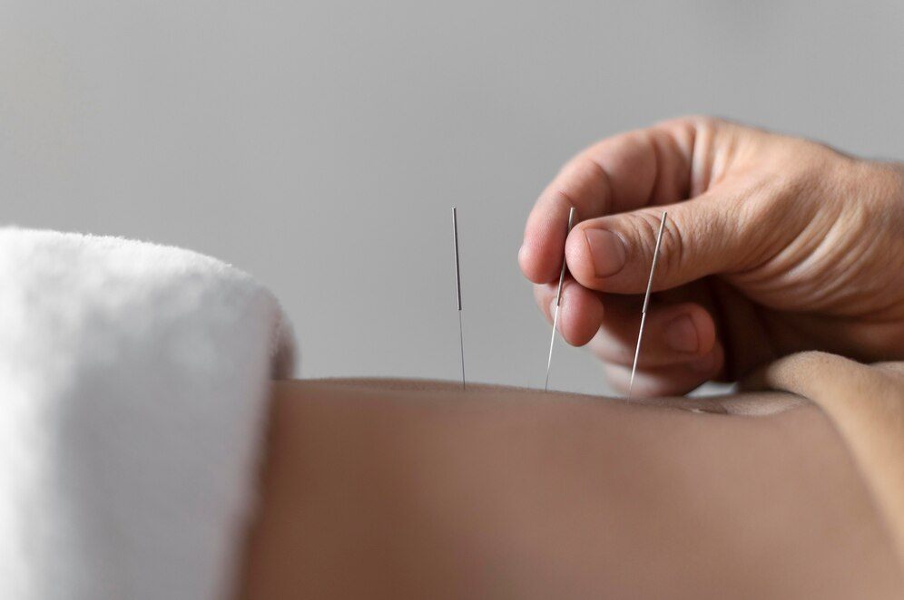 Acupuncture: An Ancient Remedy for Modern Pain Relief