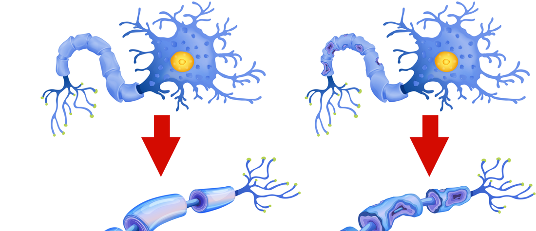 Understanding the Role of Tau Protein in Alzheimer's Disease Pathogenesis