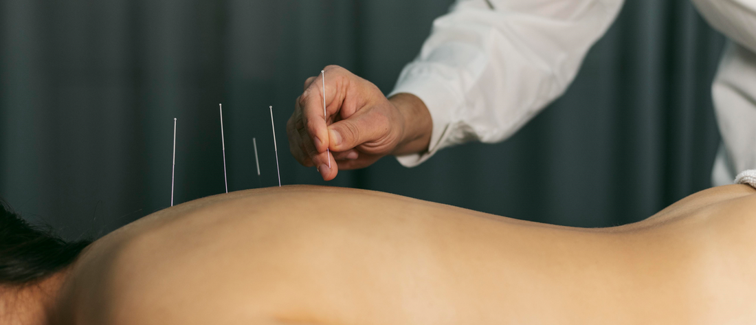 Patient experiencing the benefits of acupuncture for pain relief in a modern clinic