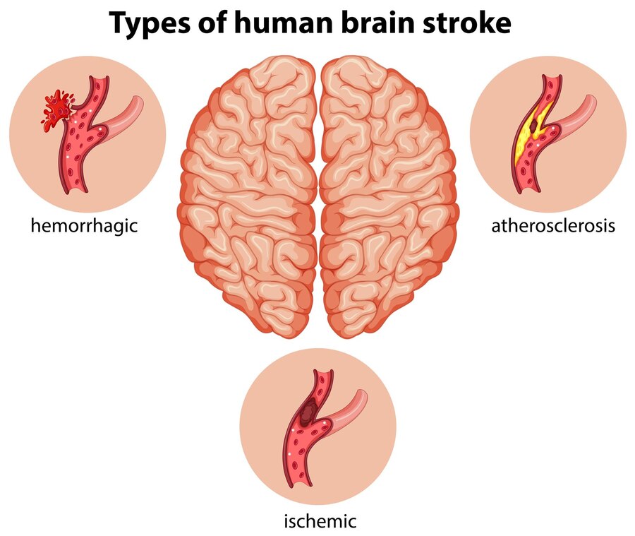 Understanding the Mechanisms of Neuroinflammation