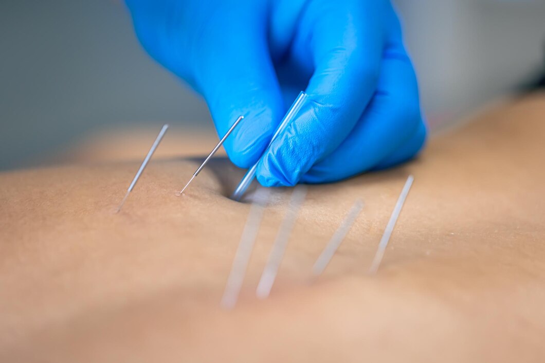 Managing Pain with Acupuncture: What to Expect