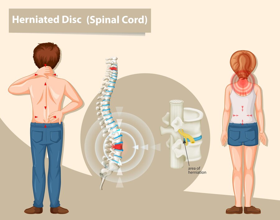 Chronic Back Pain: Identifying Root Causes and Effective Treatments